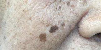 都是50歲!為何有些人皮膚上的老年斑「密密麻麻」,有的卻很乾凈?醫生說出實情